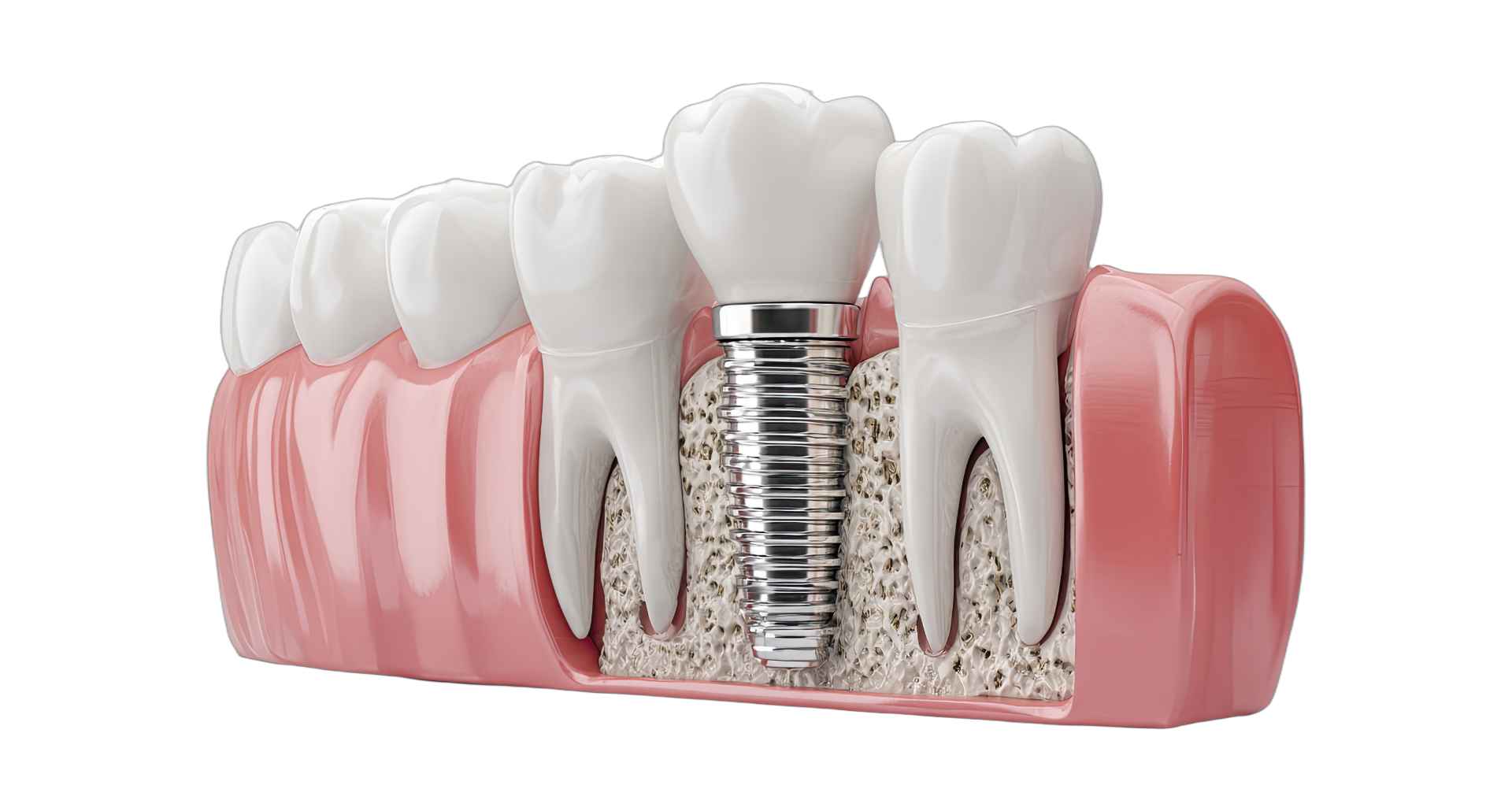 implants